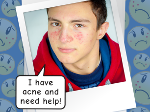 ACNE IS MAKING ME MISERABLE!!!